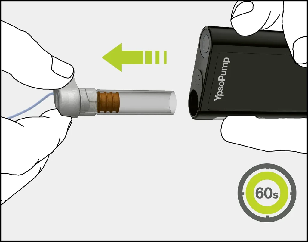 YpsoPump insulin pump